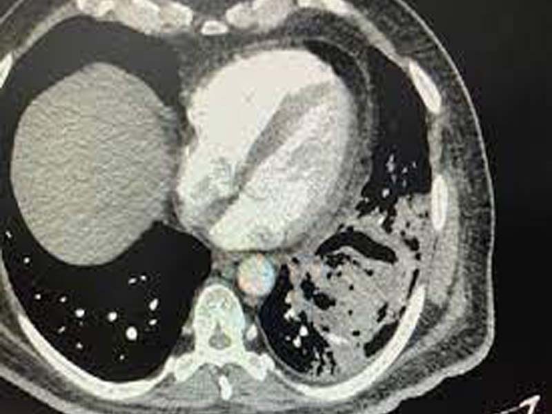 Doctors at SLG Hospitals remove “Black & White Fungus” from Lungs to save life of a 60-years-old man