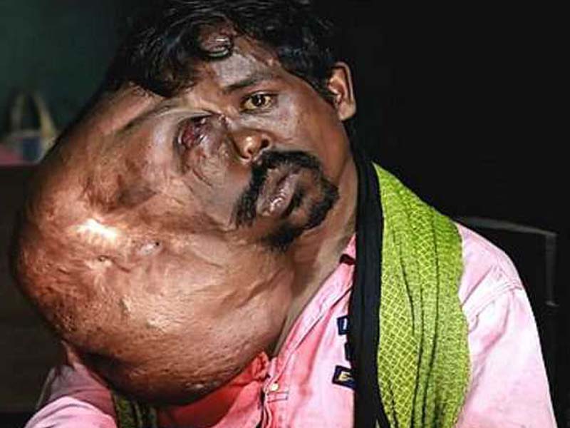 Bengaluru docs remove 8kg plus tumor on Odisha man’s face