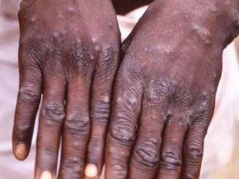 National Task Force to monitor Monkeypox cases