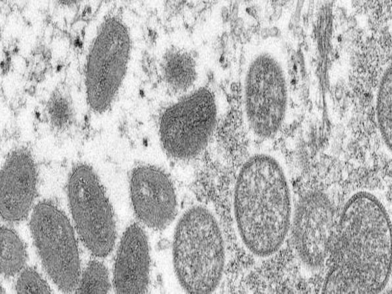 Delhi records 2nd Monkeypox case