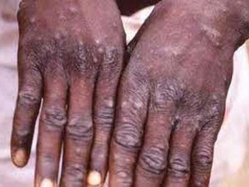 US reports 24,000 monkeypox cases