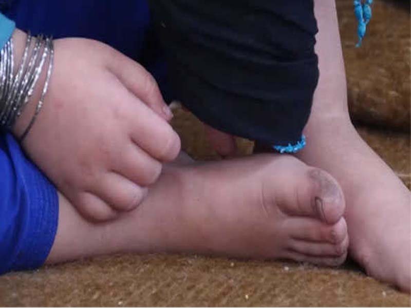 Afghanistan reports an increase in measles cases in 2024.